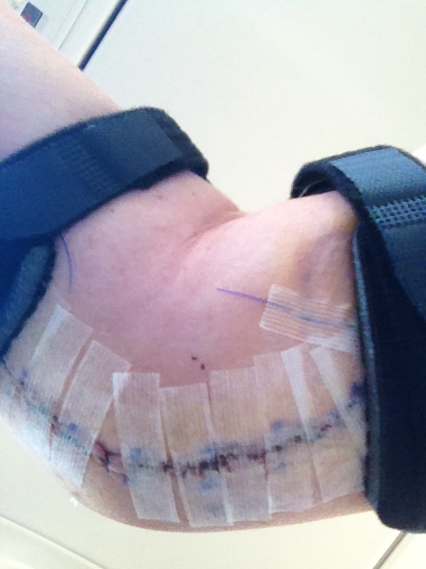Dodgers Reliever Todd Coffey Tweets Picture of Gruesome Aftermath From Tommy John Surgery (Photo)