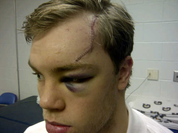 Taylor Hall Shows Off Aftermath of Taking Skate to Face With Shot of Stitches, Black Eye (Photo)