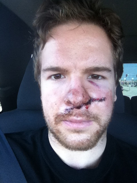 Ryan Duncan Gets Cut in Face by Skate During AHL Game, Shows Off Aftermath of 45 Stitches (Photo)