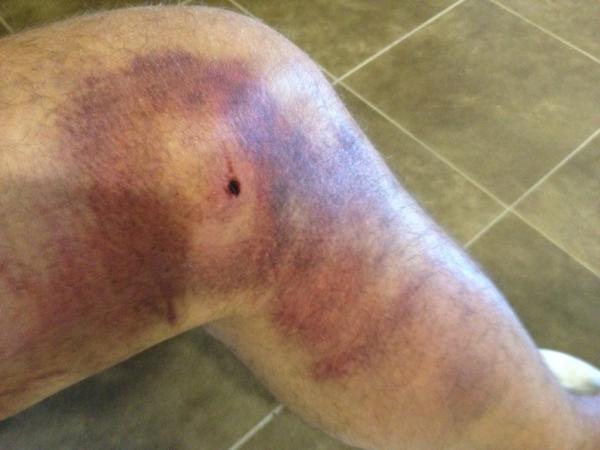 Blackhawks Defenseman Sami Lepisto Tweets Photo of Crazy Leg Bruise (Photo)