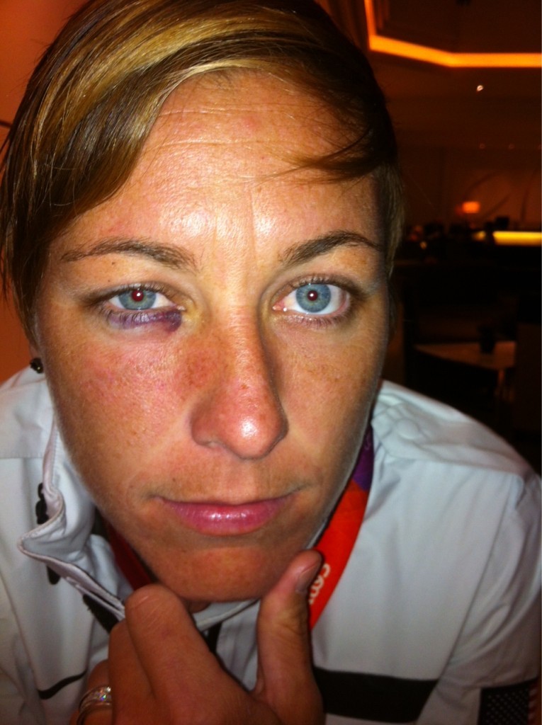 Abby Wambach Shows Off Black Eye After Getting Smacked in Face in Win Over Colombia (Photo)